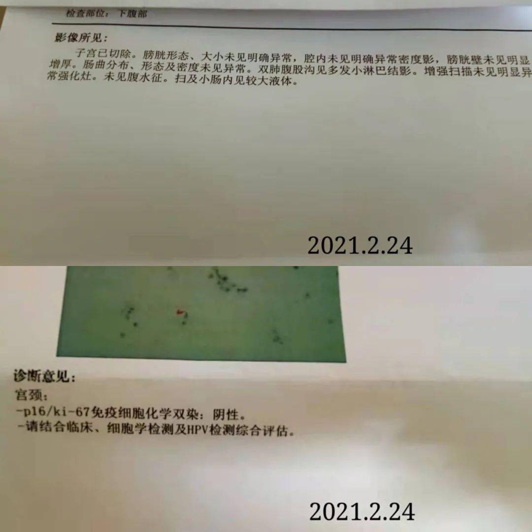 任静宫颈癌晚期 任静宫颈癌晚期