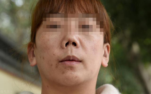 赴韩整容成植物人